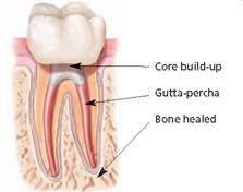 core build up gutta percha bone healed