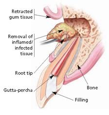 retracted cum tissue, removal of inflamed infected tissue root tip gutta-percha filling bone